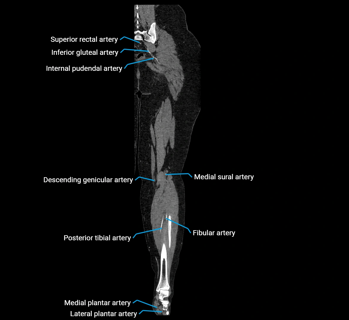 CTA lower limb coronal cross sectional anatomy labelled image _65 (2).webp